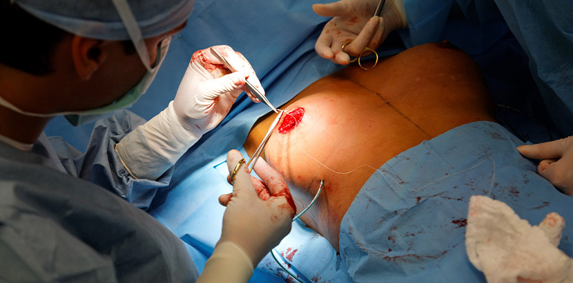 Plastischer Chirurg, der bei einer Bruststraffung die Brustwarze entfernt und neu positioniert. Bruststraffung Kosten Wien.