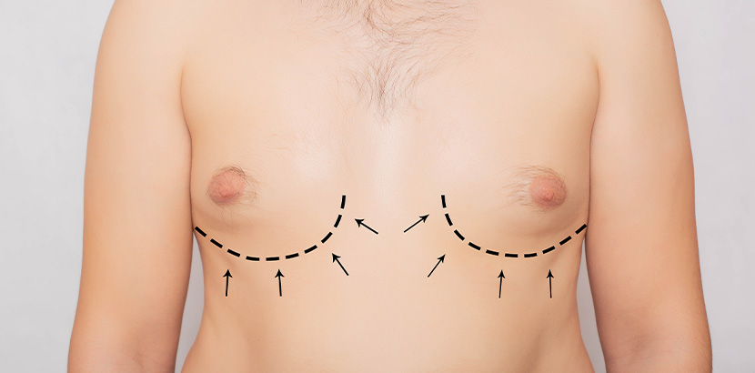 Ein Mann mit vergrößerter Brust, auf der Markierungen für eine OP sind.