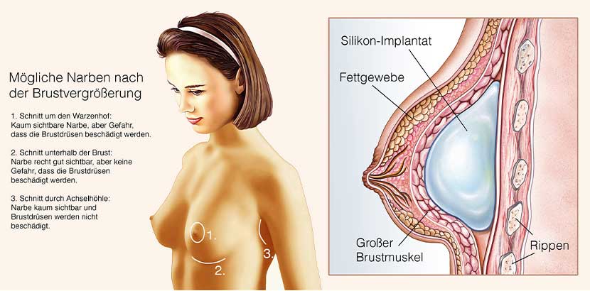 Grafik, die die Narbenbildung nach der Brustvergrößerung verdeutlicht. Brustvergrößerung Kosten Wien.