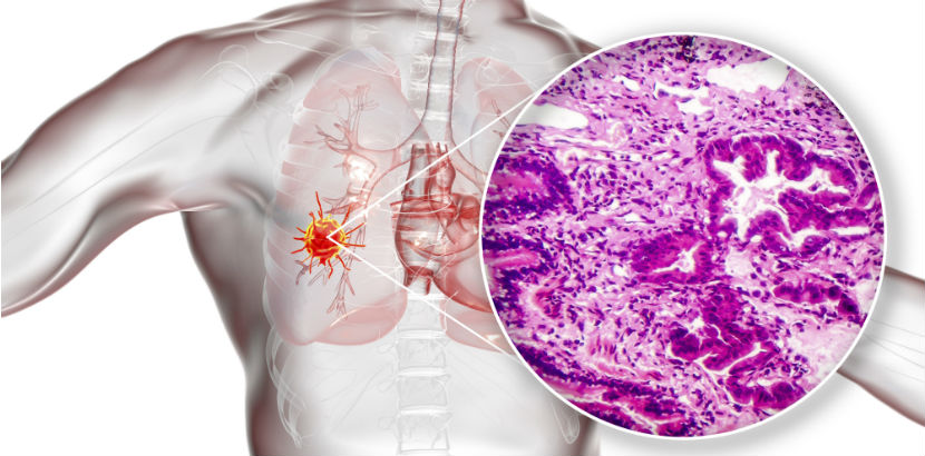 Lungenkrebs: Illustration eines Adenokarzinoms