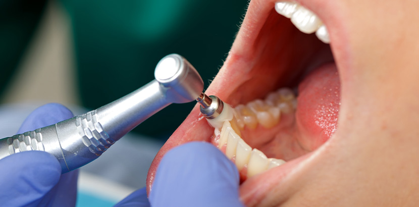 Ein Zahnarzt führt bei einem Patienten die professionelle Mundhygiene durch.