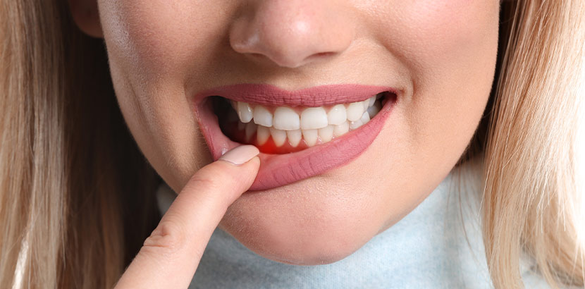 Eine Frau zieht ihre Unterlippe mit dem Zeigefinger nach unten und zeigt ihr Zahnfleisch.
