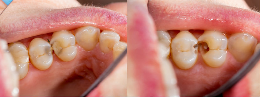 Zahnarzt Innsbruck: Vergleichsbild Zahn mit Loch und Füllung