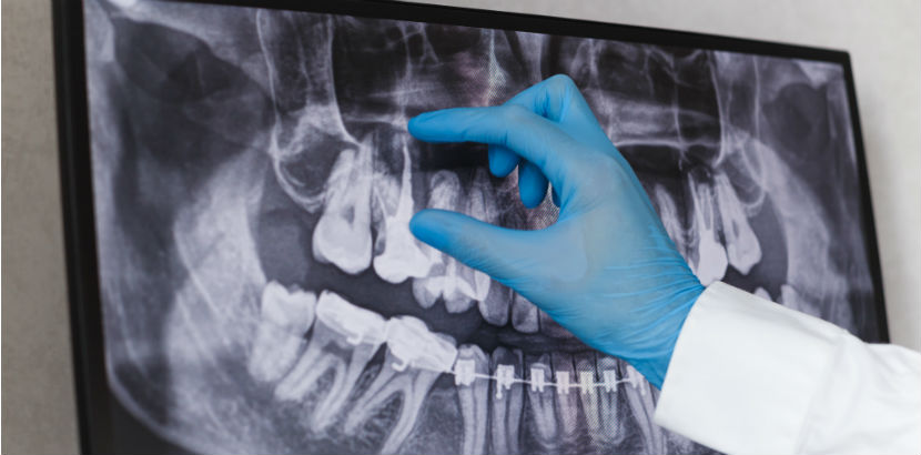 Zahnarzt Innsbruck: ein zahnärztliches Röntgenbild