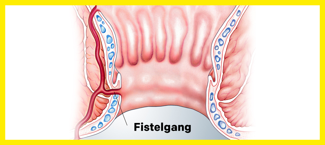 Anal Fistel