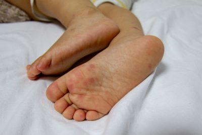 Hand-Fuß-Mund-Krankheit
