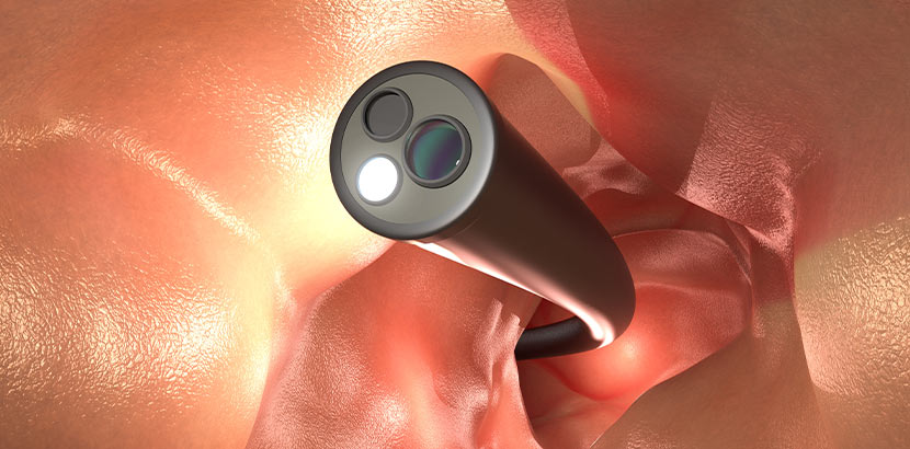 Eine Endoskopkamera während einer Darmspiegelung zur Diagnostik von Entzündungen.